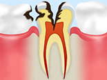 C3神経に達した虫歯