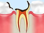 C4末期の虫歯