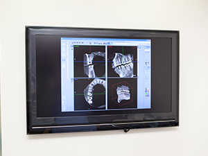 特徴2　歯科用CT撮影データをもとにしたシミュレーションの実施