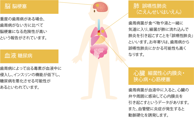 脳脳梗塞  肺誤嚥性肺炎  心臓細菌性心内膜炎・狭心病・心筋梗塞  血液糖尿病